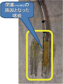 閉塞の原因となった喀痰