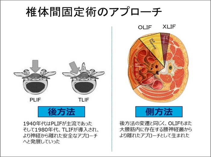 ついに始まった頸椎人工椎間板置換術！ ｜ 成尾整形外科病院