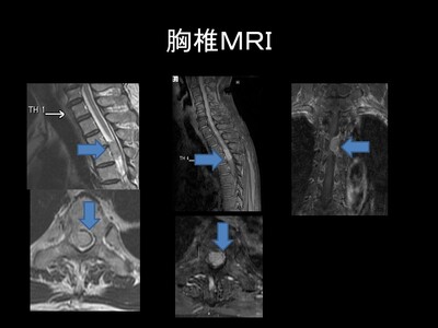 脊髄腫瘍胸椎ＭＲＩ画像.jpg
