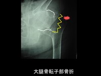 大腿骨近位部骨折 (2).JPG