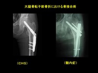 大腿骨近位部骨折 (3).JPG