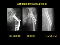 大腿骨近位部骨折 (4).JPG