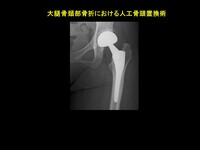 大腿骨近位部骨折12.JPG