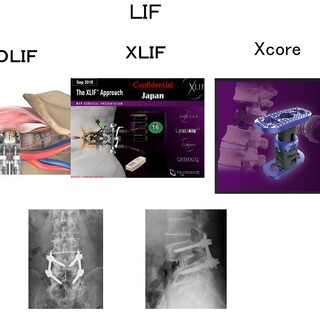 骨粗鬆症性椎体骨折に対する脊柱再建術 ｜ 成尾整形外科病院