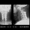 頸椎化膿性脊椎炎の治療法とは？早期発見と手術の重要性を徹底解説