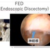 腰椎全内視鏡手術（Full endscopic surgery）の最新情報：効果と術後の生活改善を徹底解説