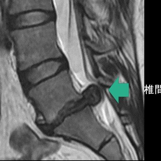 腰椎椎間板ヘルニアの自然経過：手術なしで症状改善は可能？ ｜ 成尾