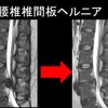 手術は必要？腰椎椎間板ヘルニアの自然経過と治療法を専門医がわかりやすく説明