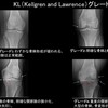 変形性膝関節症の新治療！膝動脈塞栓術（GAE）で痛みから解放される方法