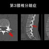 スポーツ少年に多い腰椎分離症、保存治療で骨は治るのか？