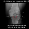 膝の痛みを改善？体外衝撃波療法（ESWT）の効果とは？