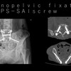 骨盤の脆弱性骨折とは？高齢者に多い原因・症状・治療法を徹底解説