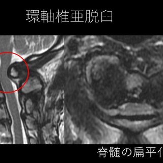 脊椎専門医が解説！環軸椎亜脱臼の新しい分類と治療法 ｜ 成尾