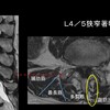 腰部脊柱管狭窄症の手術成功率を左右する