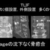  腰椎固定術の成功を左右する「ケージ沈下」とは？」リスクと対策を専門医が解説