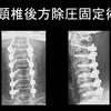   75歳以上でも手術は有効？特定疾患、頸椎後縦靱帯骨化症の治療成績を徹底解説！