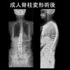 成人脊柱変形と仙腸関節痛の関係性：成人脊椎変形の手術で仙腸関節痛が改善するのは本当？