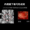 足踏みテストでわかる！脊柱管狭窄症手術後の下肢回復パターン。馬尾型は要注意？
