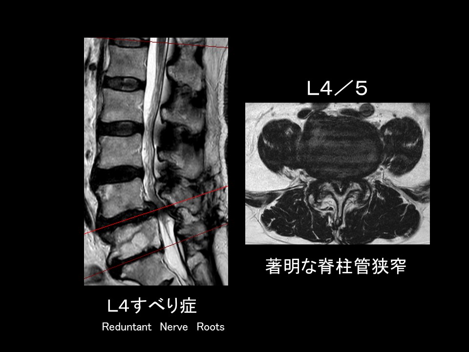 すべり症MRI.jpg