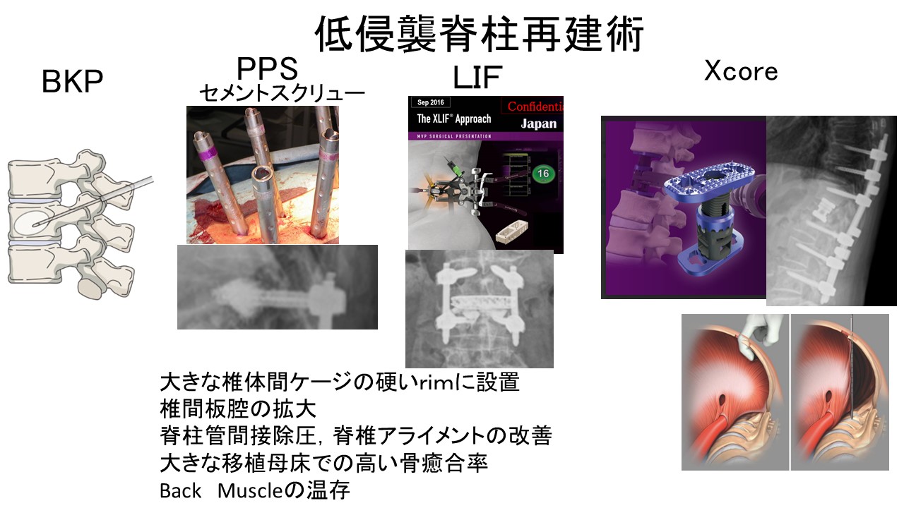 ガイドライン脊柱再建３.jpg