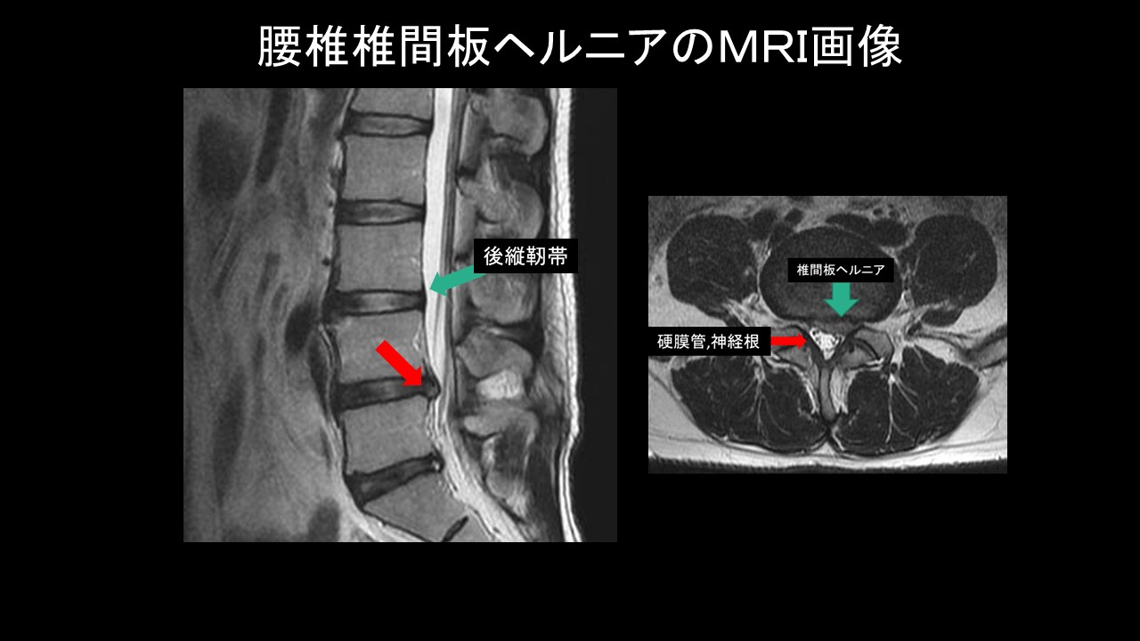 ヘルニアＭＲＩ画像見本.jpg