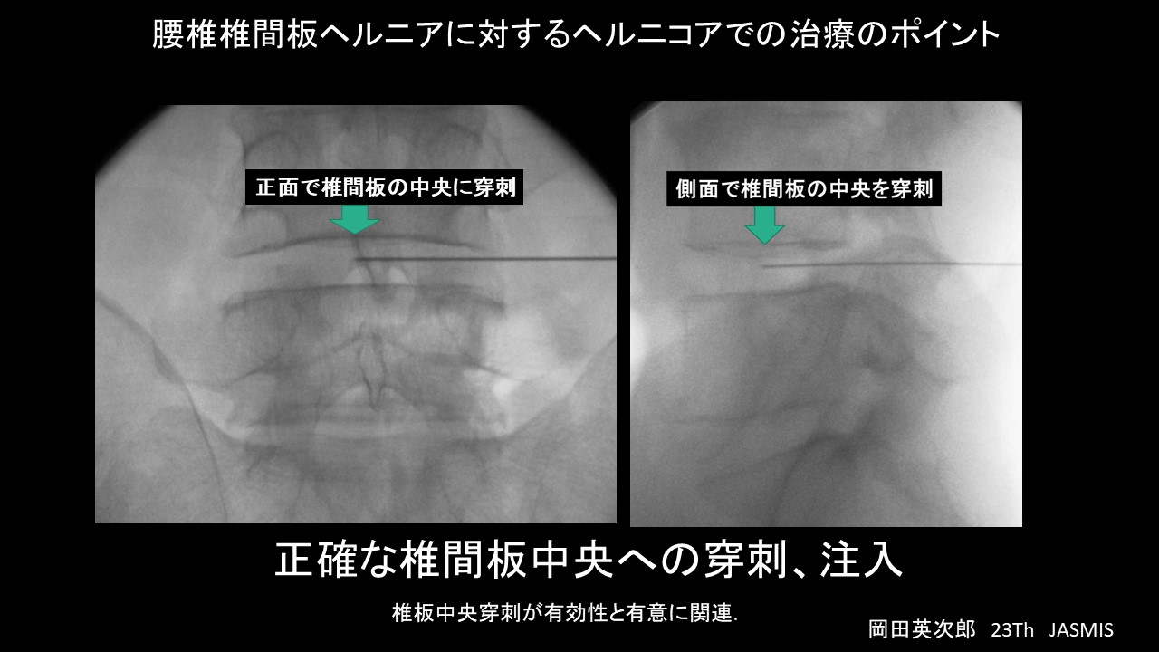 ヘルニコアポイント.jpg