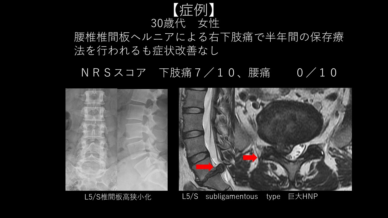 ヘルニコア症例１.jpg