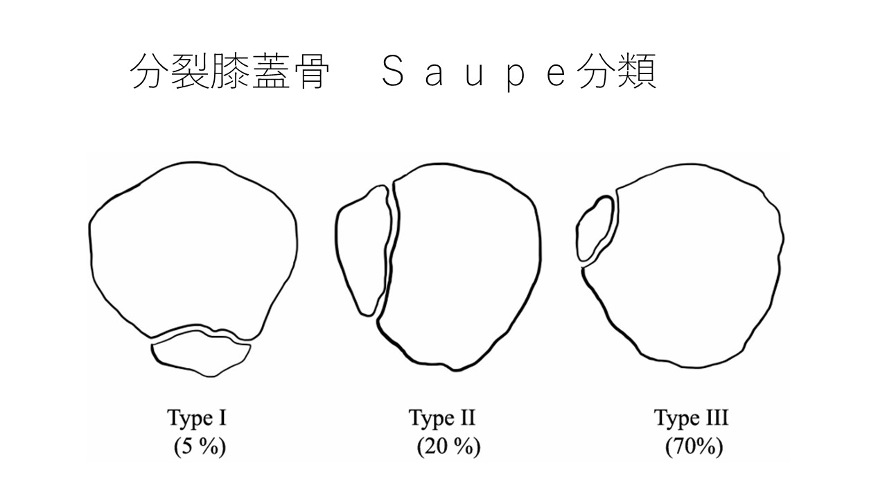 分裂膝蓋骨分類.jpg