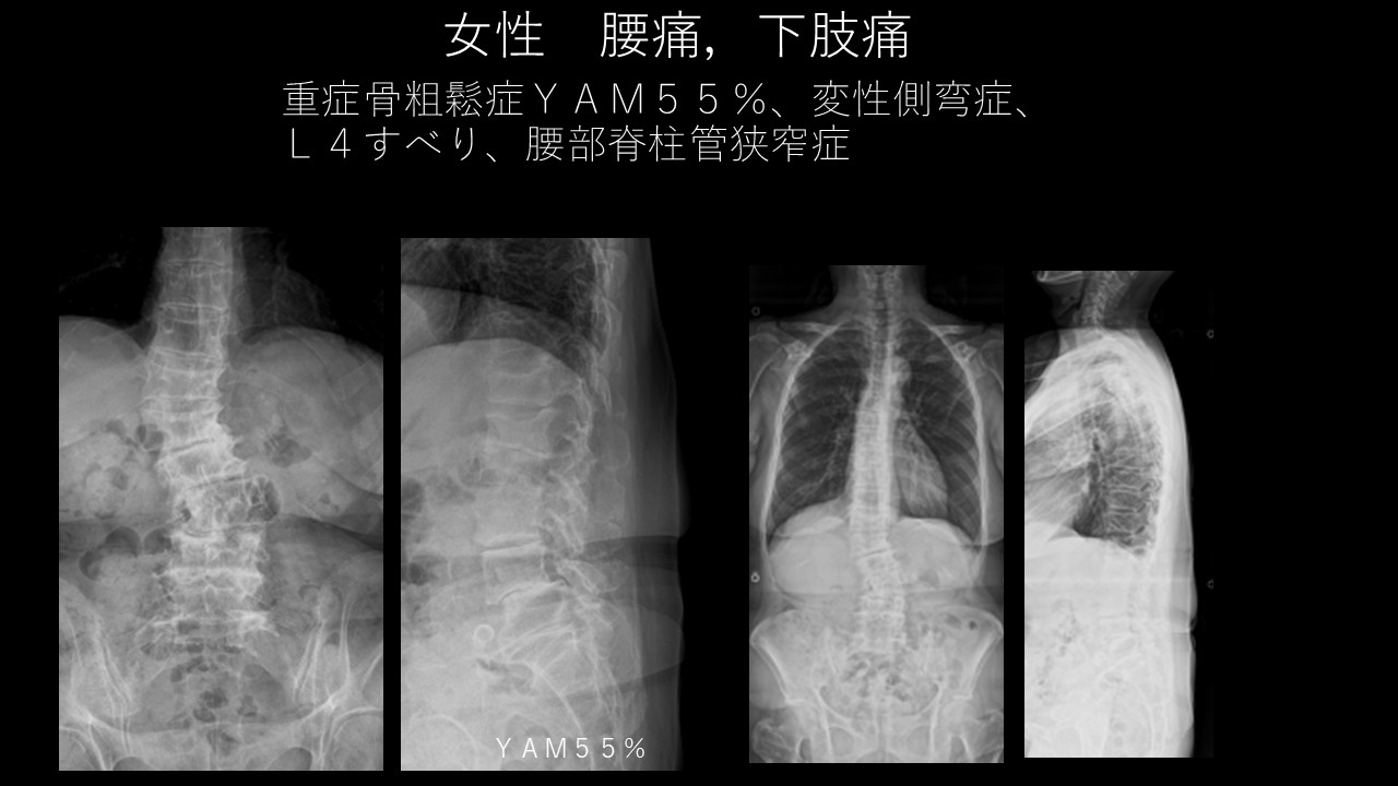 変性側弯１.jpg