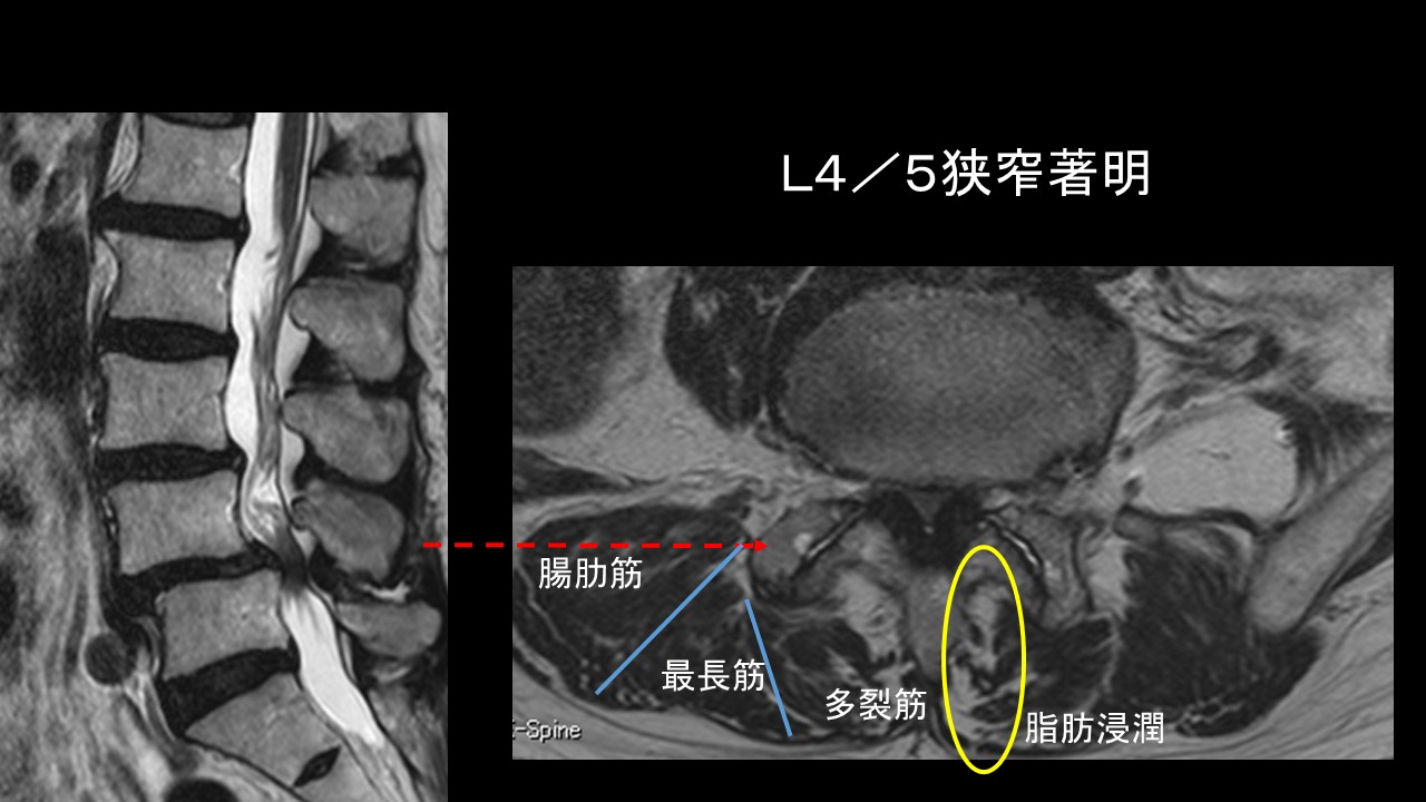 多裂筋脂肪浸潤.jpg