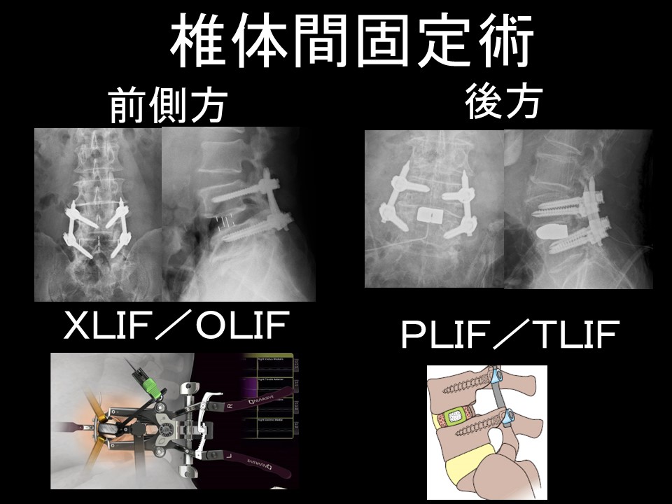 椎体間固定.jpg