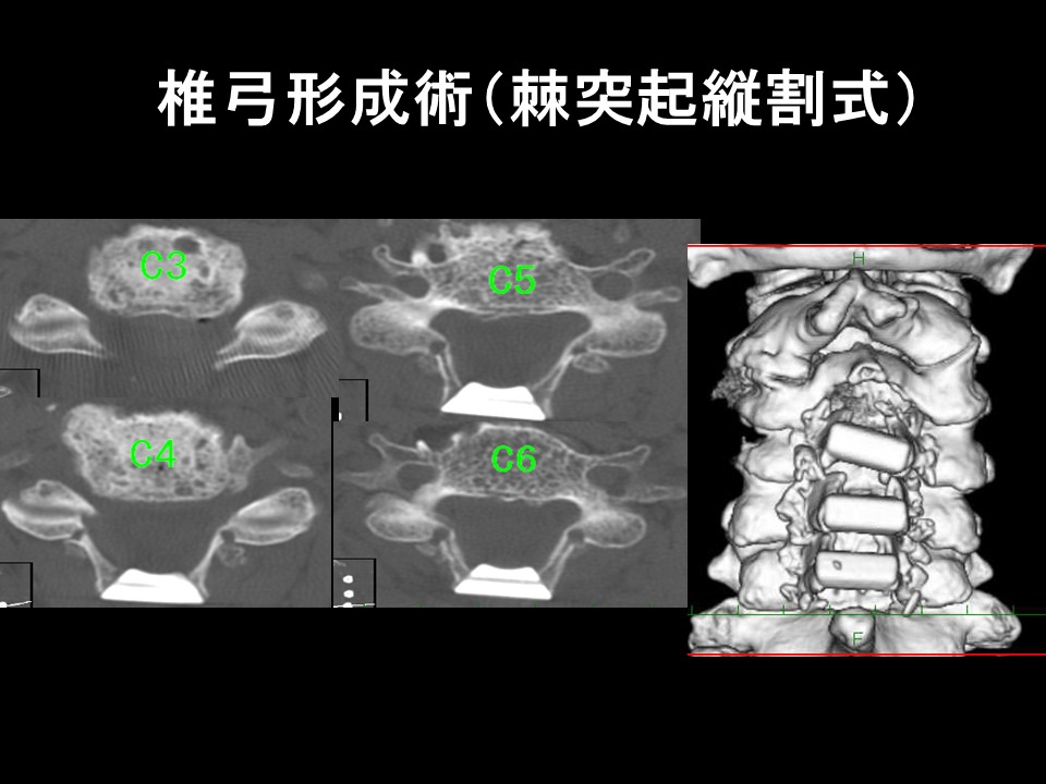 椎弓形成術ＯＰＬＬ.jpg