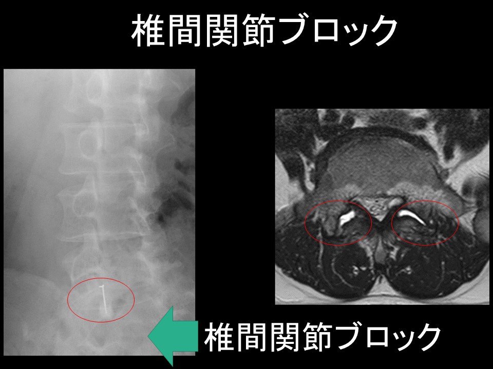 椎間関節ブロック.jpg