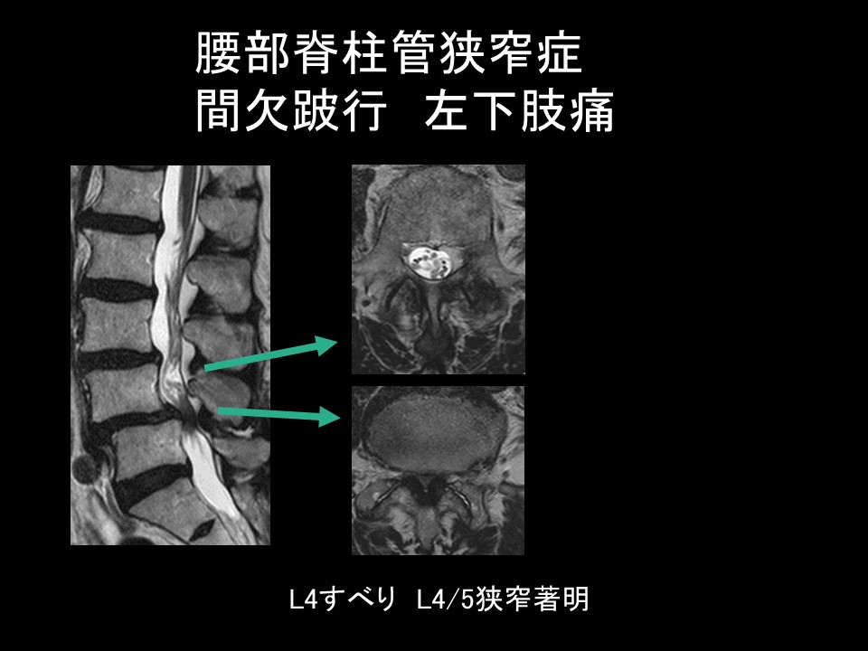 狭窄すべりＭＲＩ画像.jpg