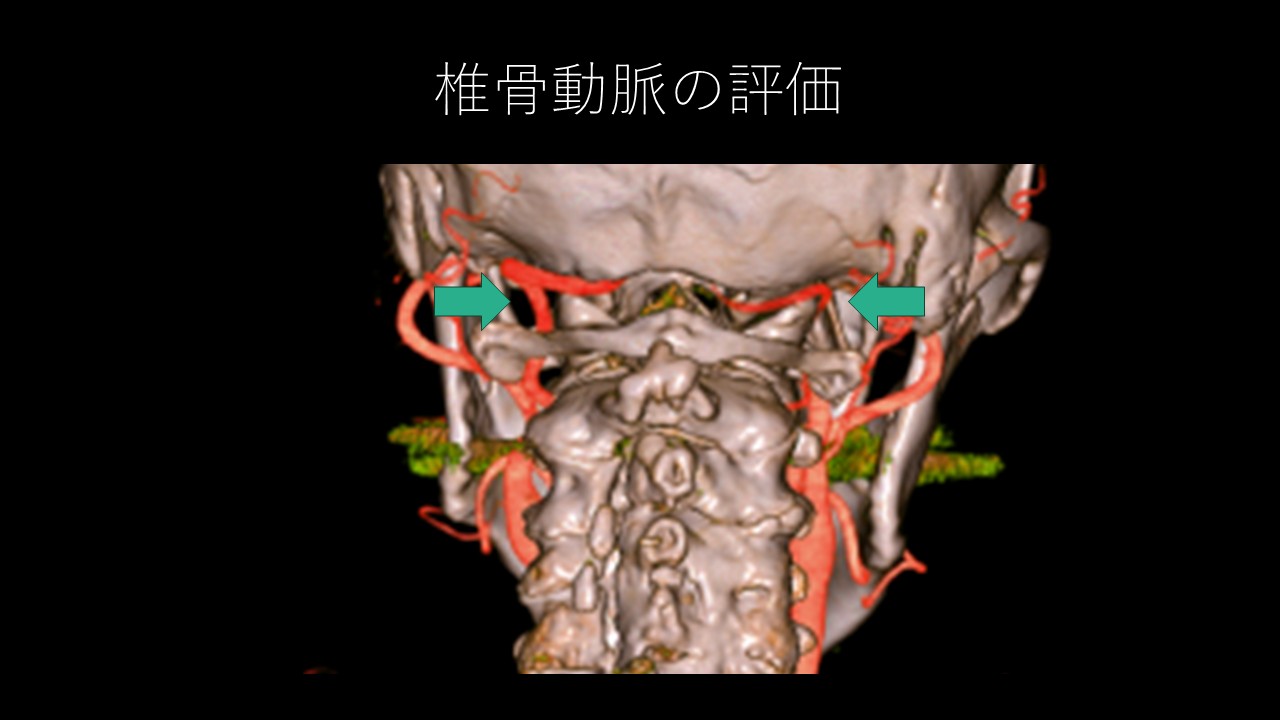 環軸椎ＶＡ評価.JPG