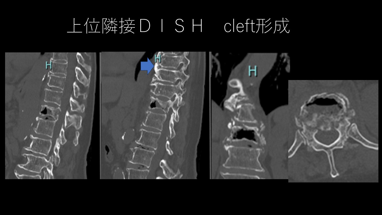 破裂骨折症例１.JPG