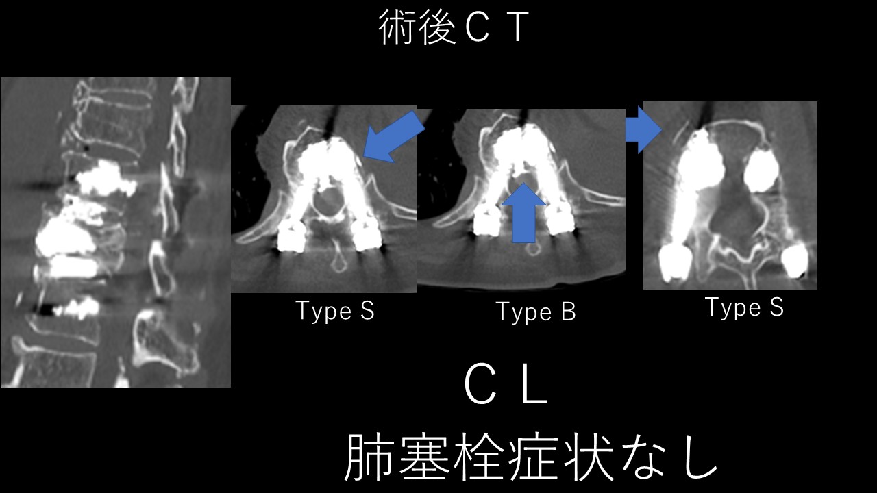 破裂骨折術後ＣＴ.JPG