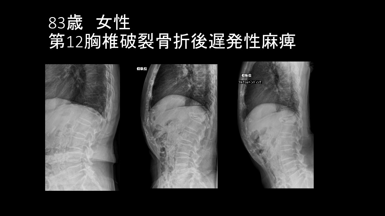 破裂骨折麻痺.JPG