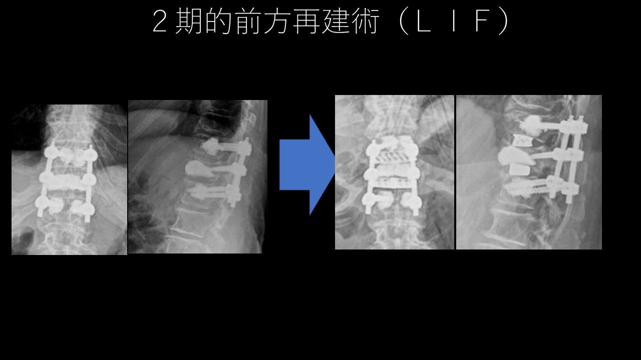 破裂骨折ＢＫＰとＬＩＦ.JPG
