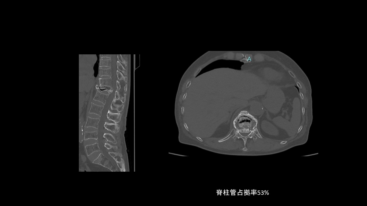 破裂骨折ＣＴ.JPG