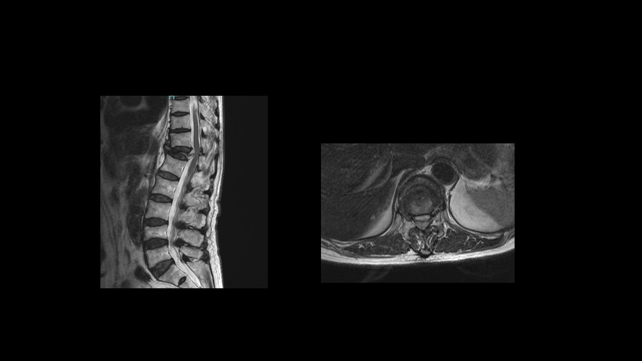 破裂骨折ＭＲＩ.JPG