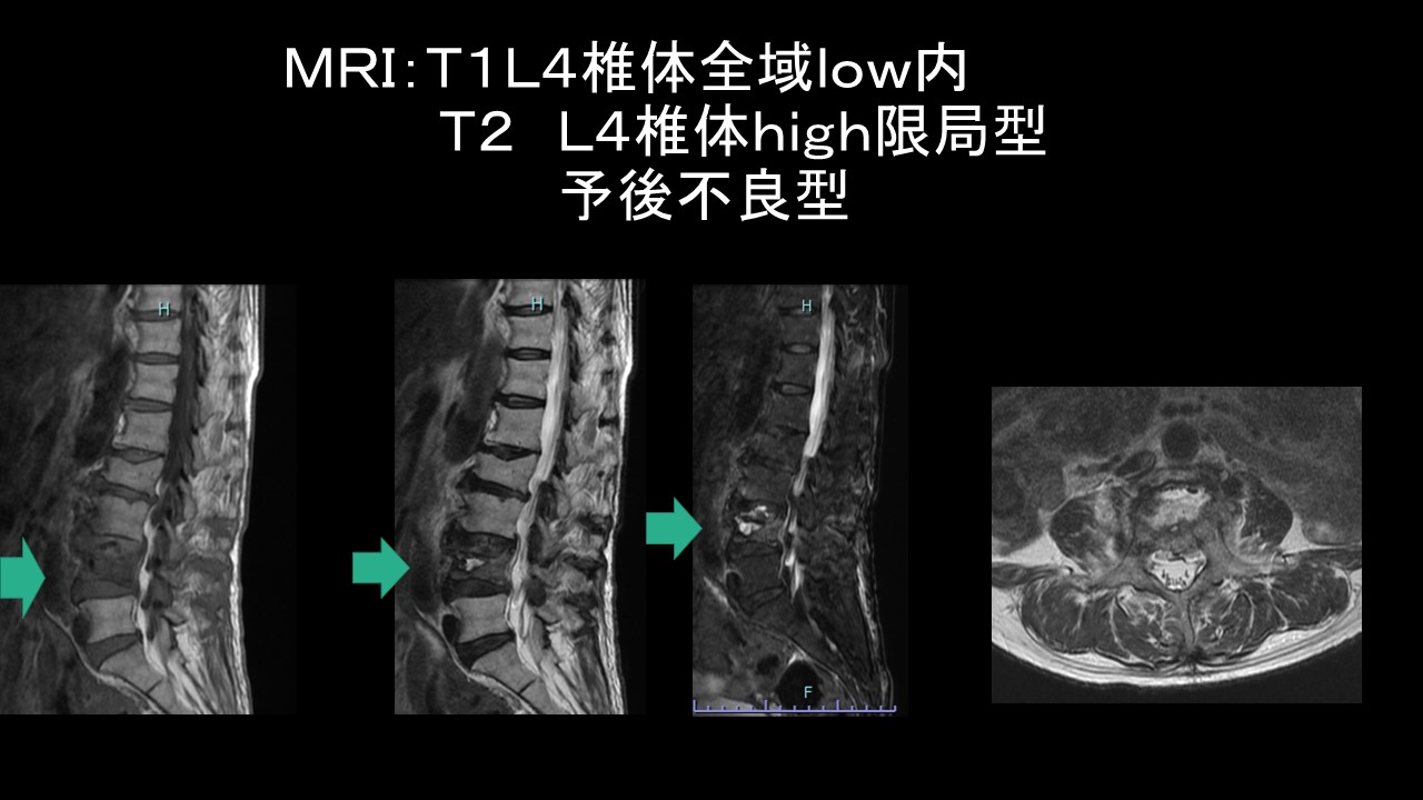 破裂骨折MRI予後不良型.JPG