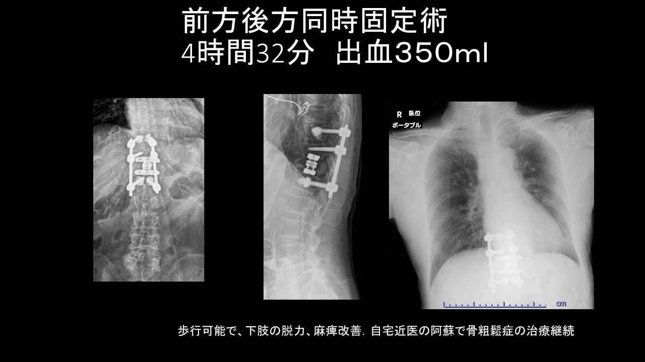 破裂骨折Xcore.JPG