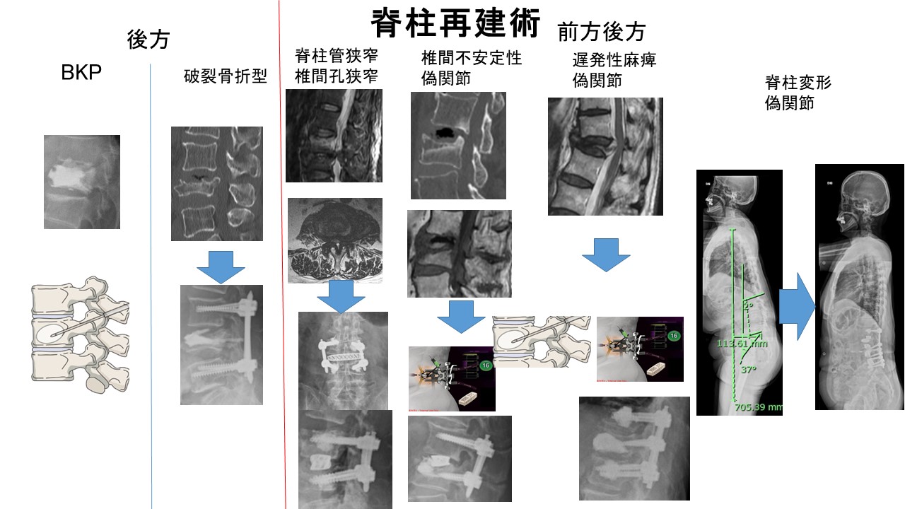 脊柱再建術.jpg