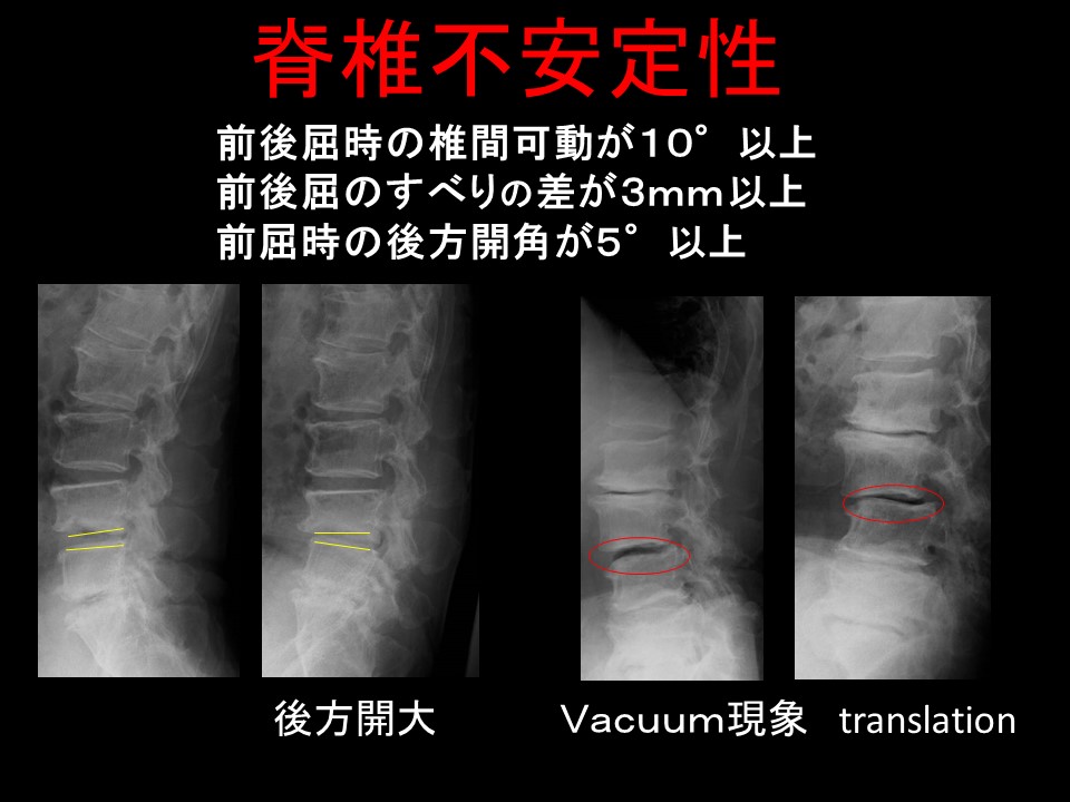 脊椎不安定性.jpg