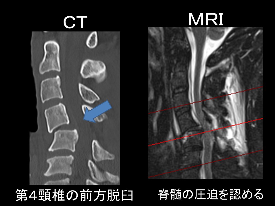 脊髄損傷画像.jpg