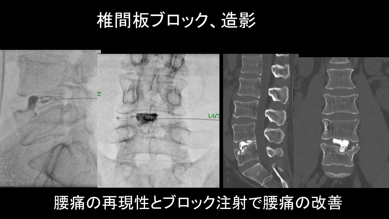 腰痛椎間板ブロック.JPG