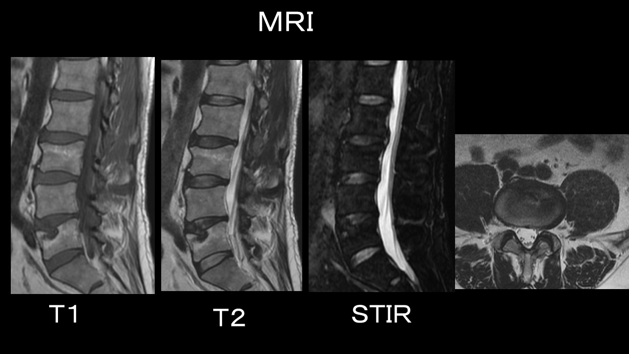 腰痛ＭＲＩ.JPG