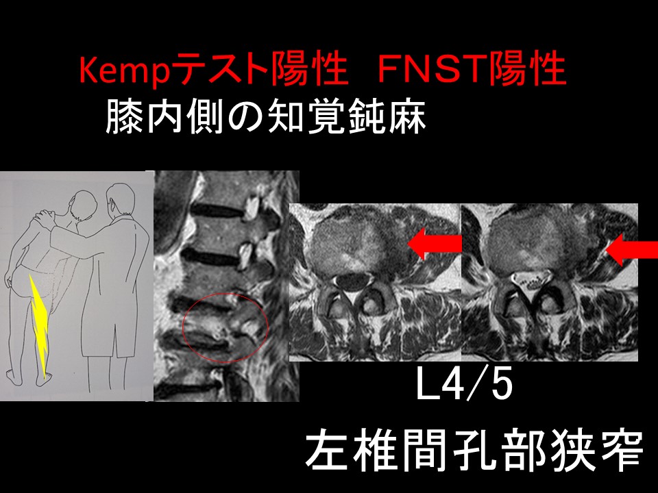 膝痛３.JPG