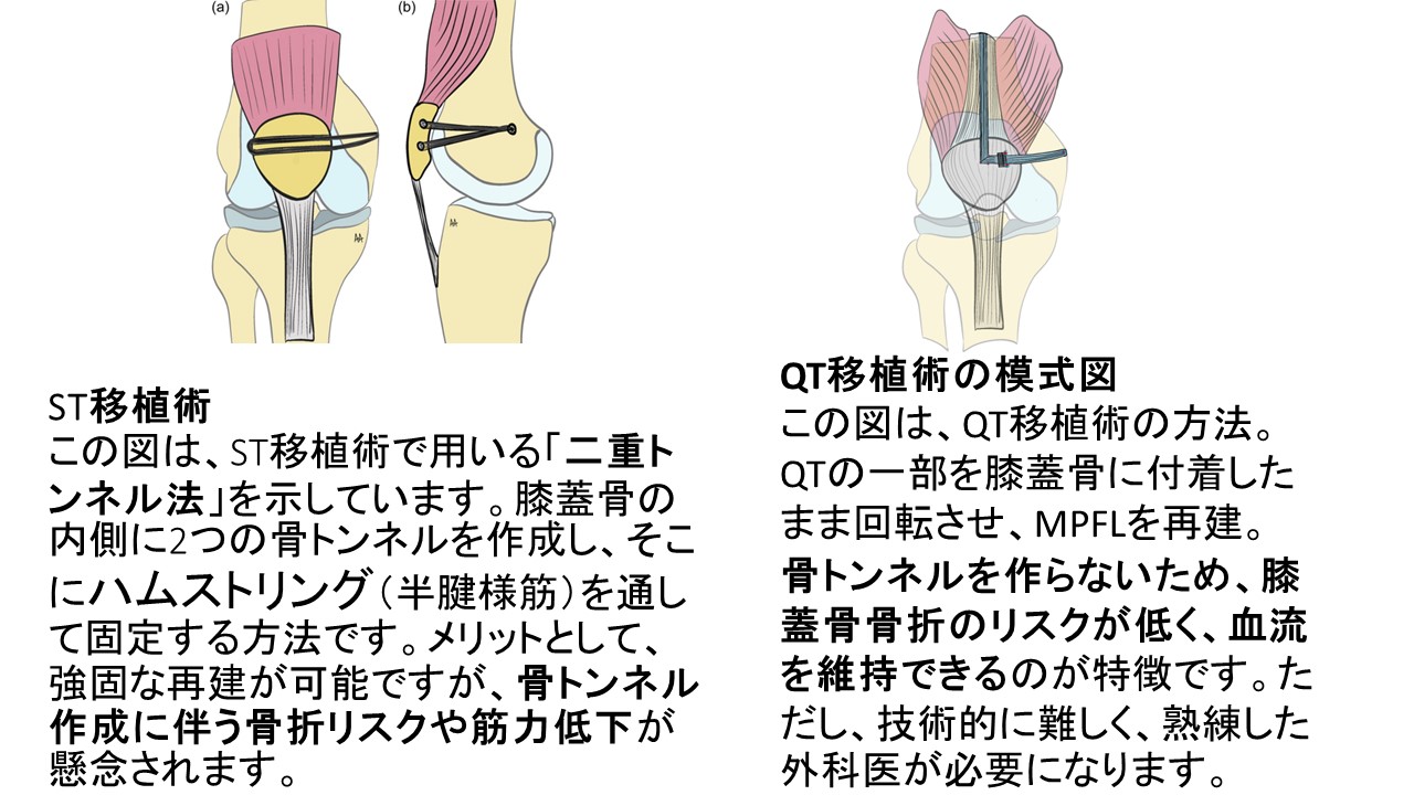 膝蓋骨脱臼MPFL.JPG